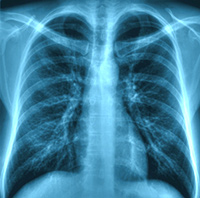 chestxray2